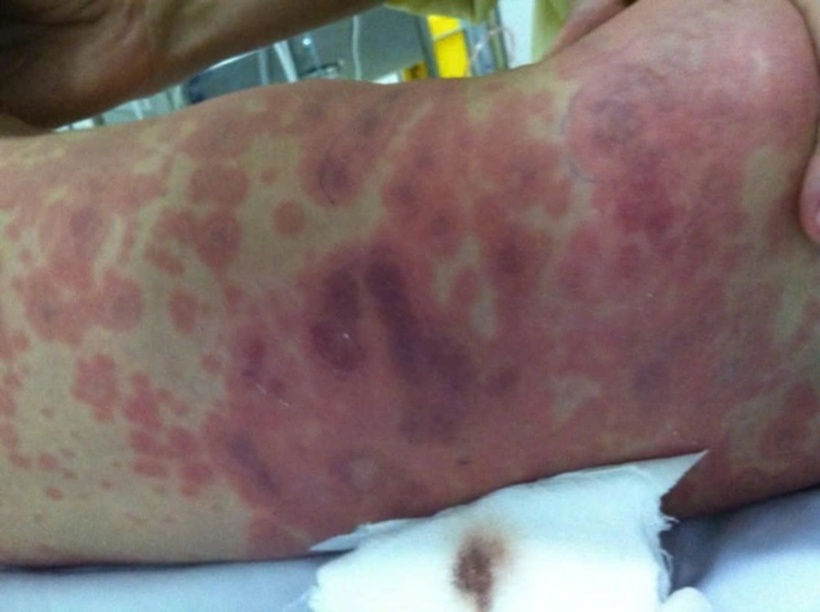 Ghi nhận bé gái mắc viêm não mô cầu. Ảnh minh họa