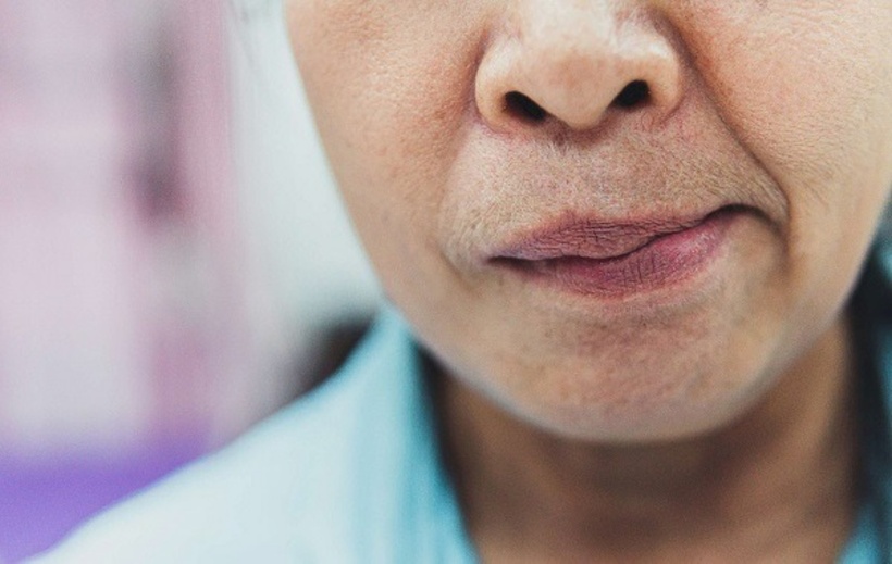 Nhiều người sau khi bị méo miệng, nói ngọng hoặc tê tay chân trong vài phút rồi tự hết. Điều này khiến người bệnh và người thân dễ nghĩ rằng mọi chuyện không sao và không đi khám. Ảnh minh họa.