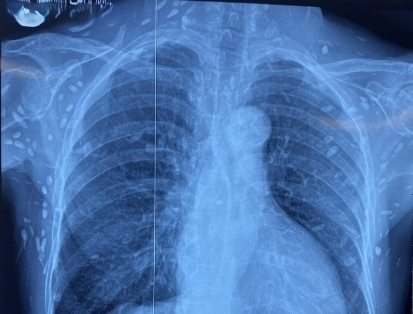 Nhiều nốt cản quang dưới da thành ngực - bụng và chi trên của bệnh nhân. Ảnh: Tạp chí Tri Thức.