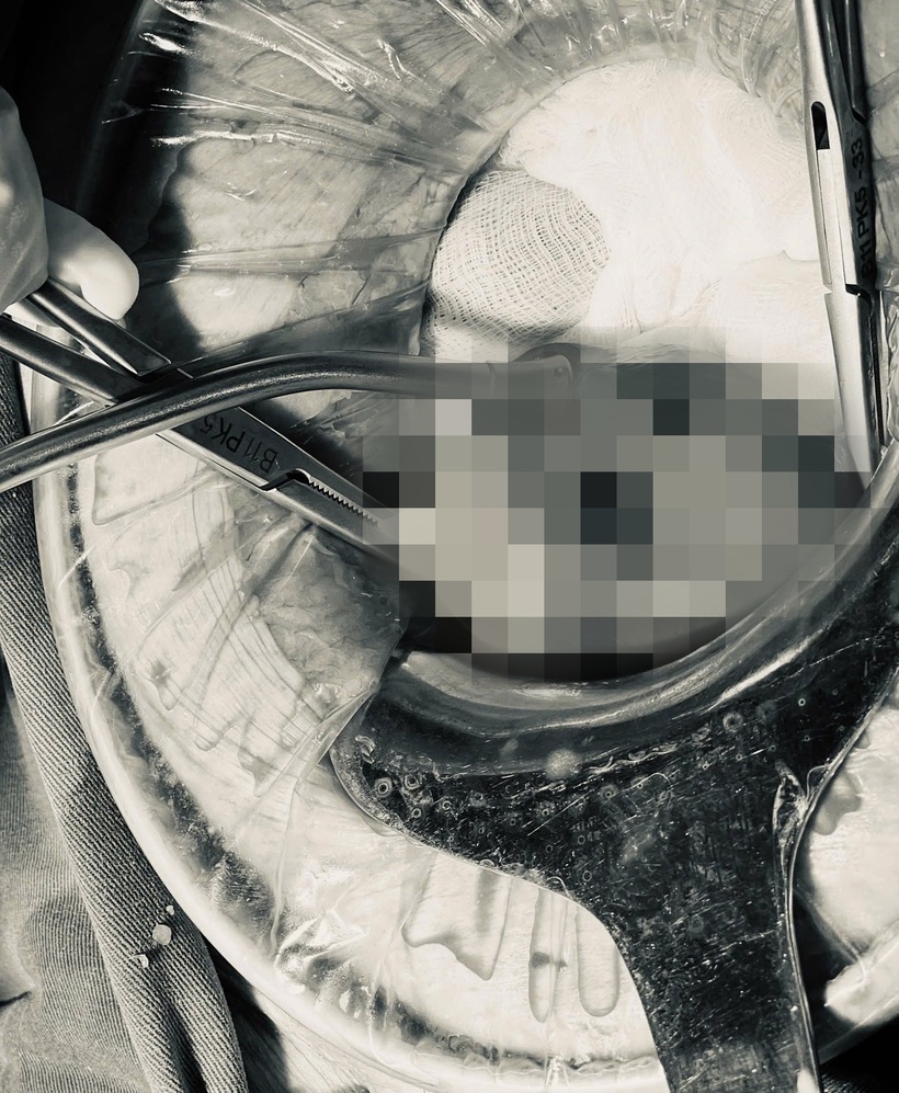 Cụ bà gặp tình trạng đau bụng 1 tuần, táo bón, tiếp xúc chậm, vào viện phát hiện thủng tử cung. Ảnh: BVCC