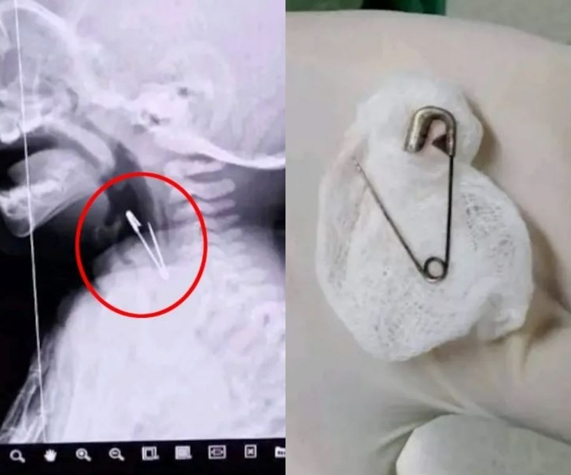 Chiếc ghim lớn đã mắc kẹt ở hạ họng của em bé, phần dưới của cổ họng. Ảnh: Người đưa tin.
