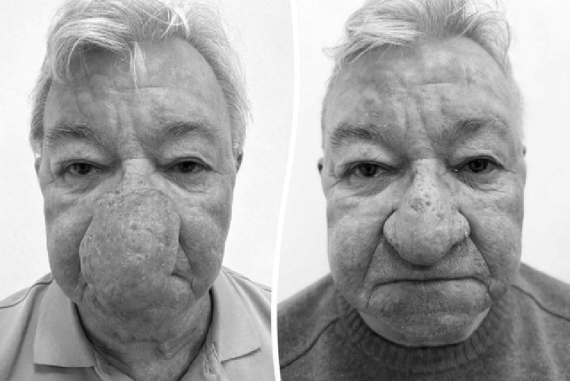 Ông Gerard McAliece trước và sau khi phẫu thuật. Ảnh: Ever Clinic/SWNS.