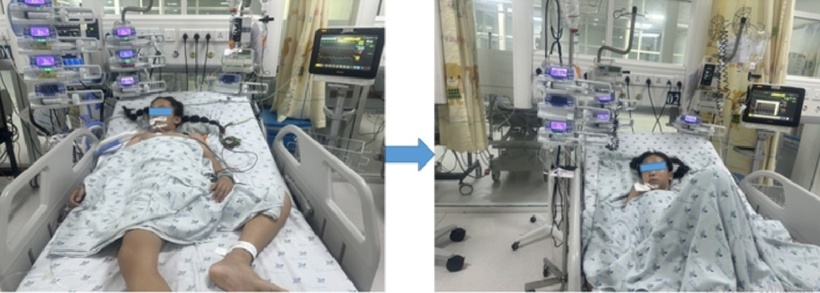 Bệnh nhi đang được điều trị tại Bệnh viện Nhi đồng Thành phố. Ảnh: Báo Người lao động.