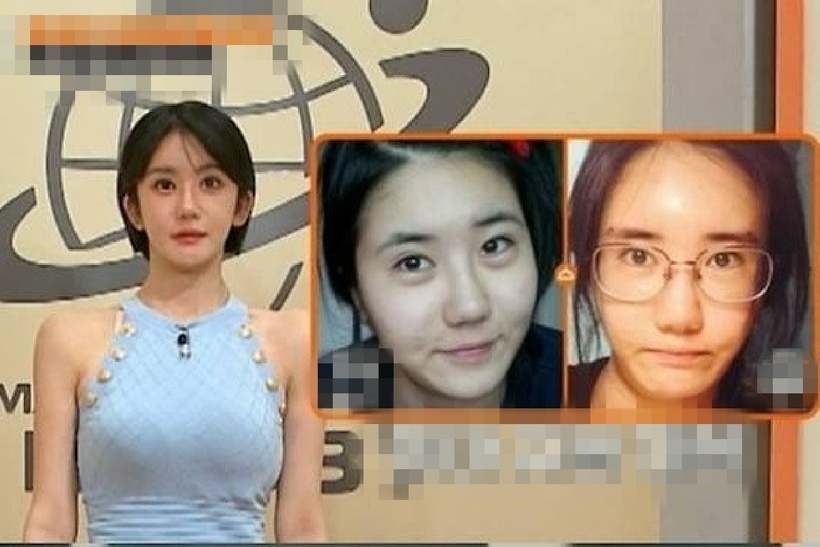 Gil trước và sau khi thẩm mỹ. Ảnh: Tạp chí Tri thức.