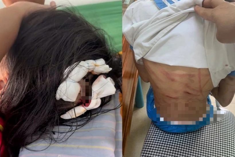 Hình ảnh bé L. bị cha dượng bạo hành. (Ảnh: VietnamNet)