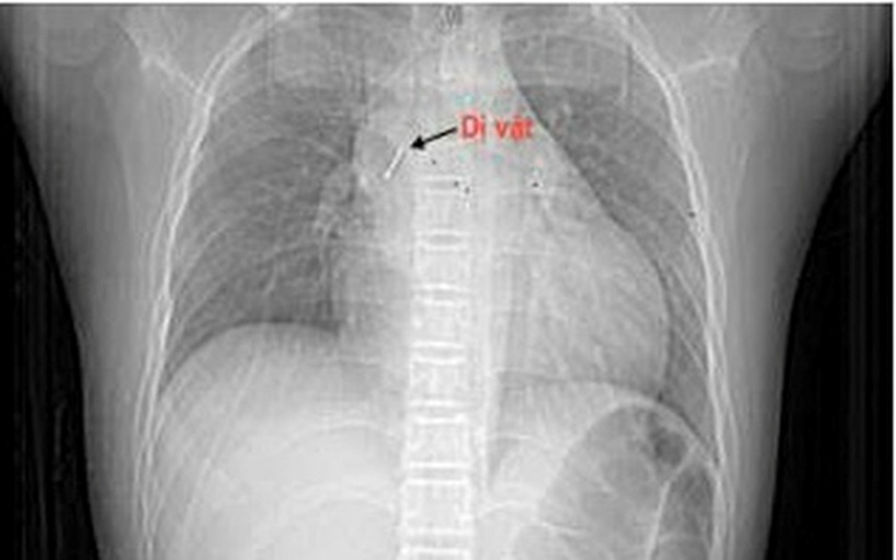 Dị vật trong đường thở bệnh nhi. Ảnh: Sức khỏe & Đời sống.