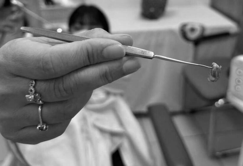 Dị vật được lấy ra từ mũi bệnh nhi. Ảnh: Sức khoẻ & Đời sống.