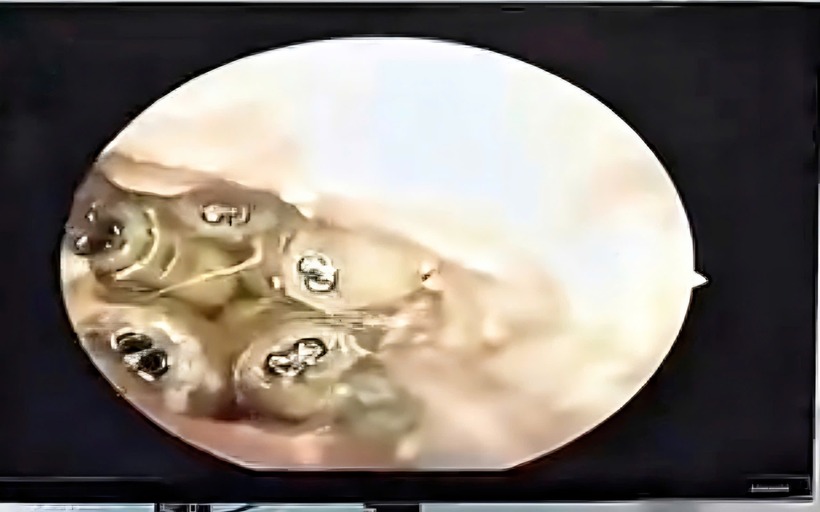 5 con giòi trong tại của bệnh nhân. Ảnh: Sức khoẻ & Đời sống.