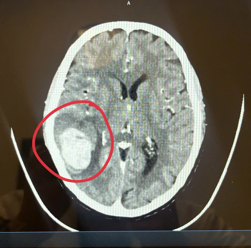 Hình ảnh khối xuất huyết não của bệnh nhân. Ảnh: BSCC