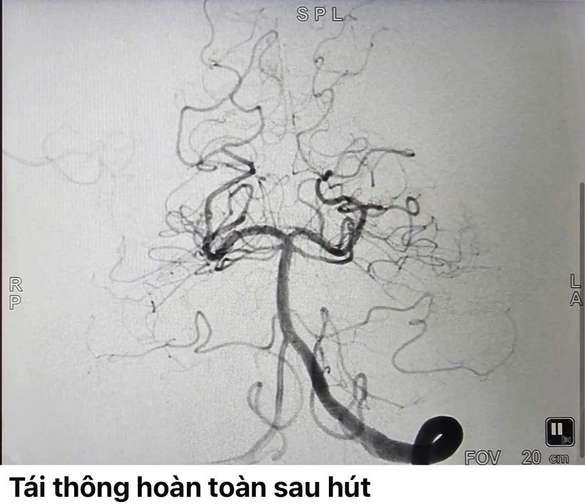 Hình ảnh tái thông mạch máu sau hút