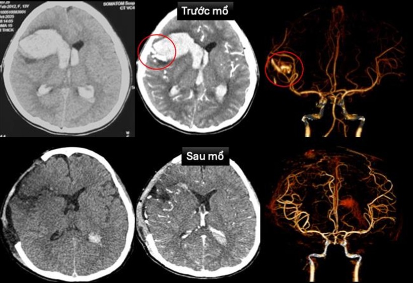 Hình ảnh chụp cắt lớp vi tính sọ não và dựng hình mạch máu não trước mổ và sau mổ.  Ảnh: VietNamNet.
