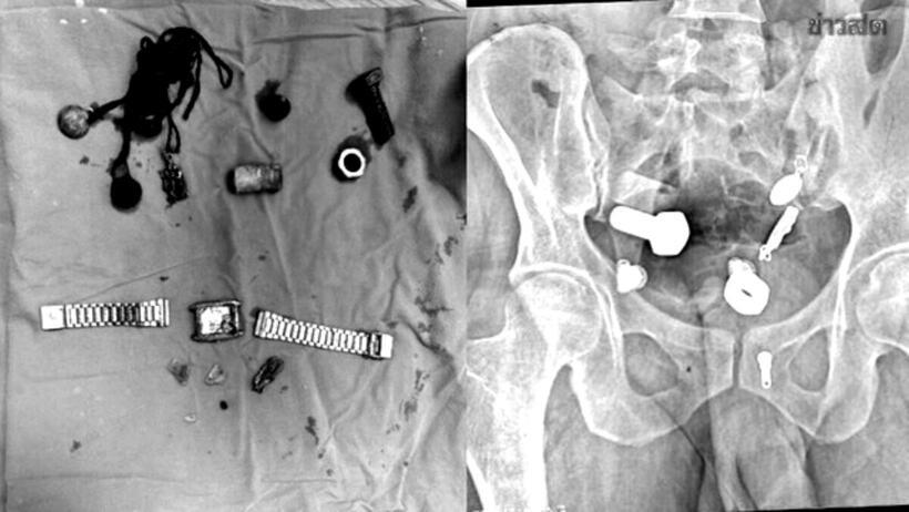 Dị vật được lấy ra từ bụng người đàn ông.