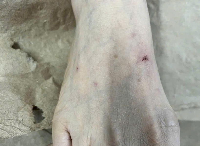 Sau khi bị mèo nhà cắn, bệnh nhân đã tự xử lý sai cách bằng hành động nặn máu và bôi nước chanh lên vết thương. Ảnh: Vnexpress.