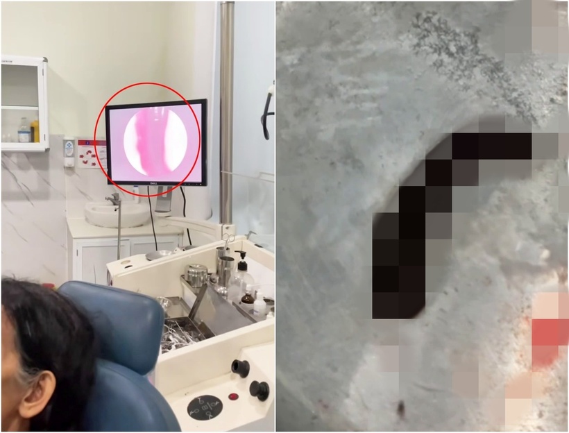 Con đỉa dài được gắp ra ngoài. Ảnh: Sức khỏe & Đời sống.