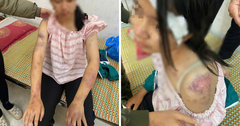 Cháu P.A với nhiều vết bầm tím trên cơ thể.