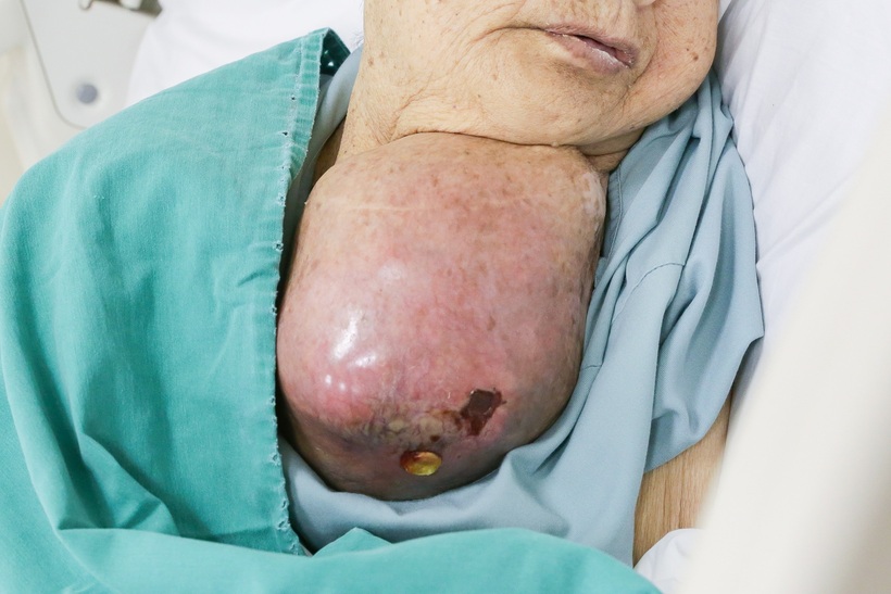 Bóc thành công khối u quái gần 2kg chèn ép vùng cổ cụ bà 81 tuổi - 3