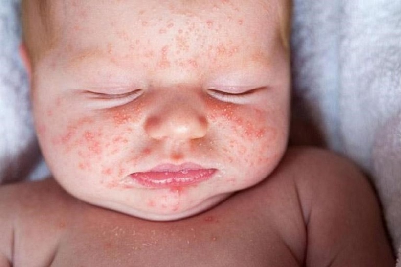 Cha mẹ cần ngăn bé cào gãi, tránh làm xước da.