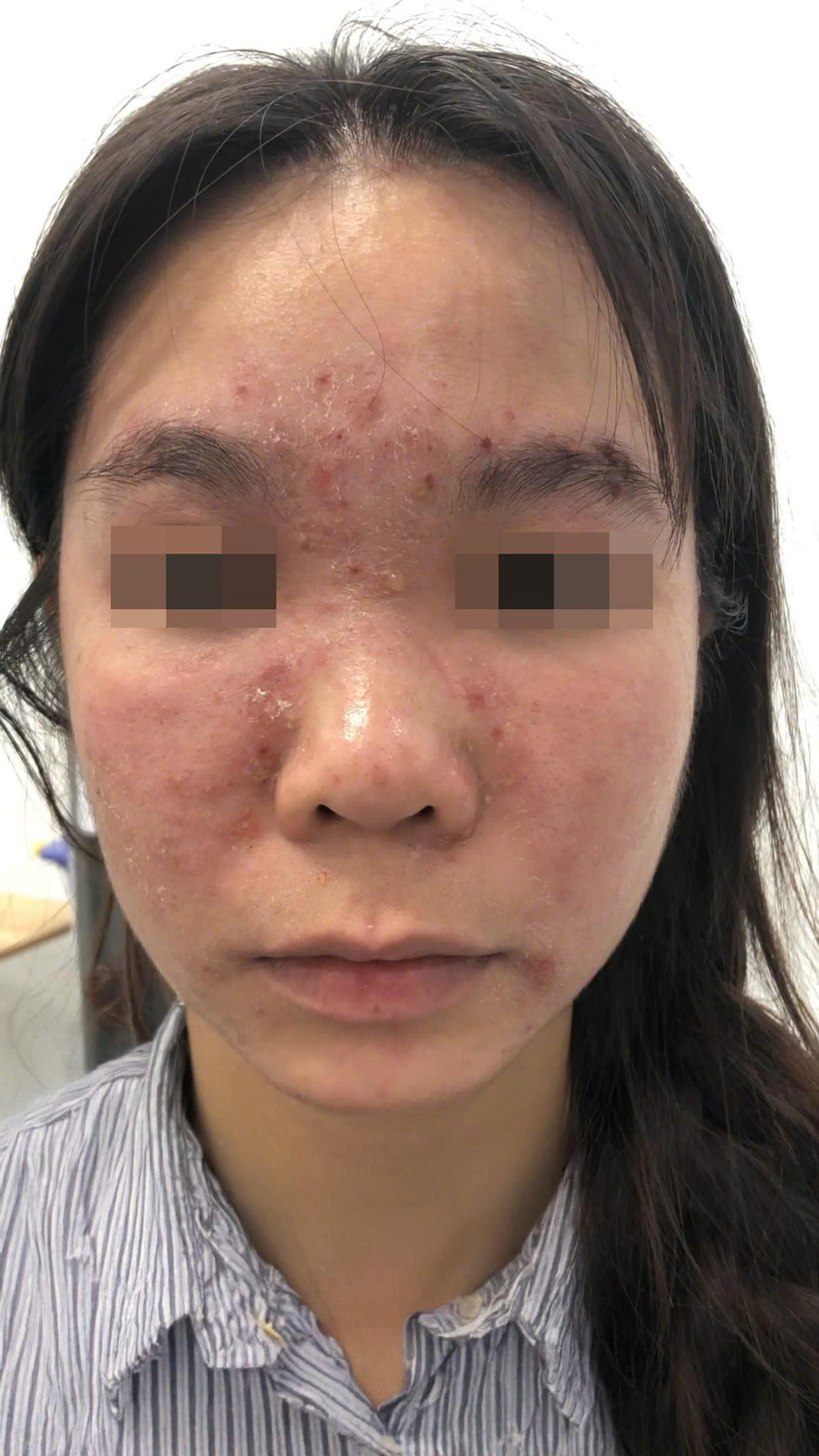 Dùng mỹ phẩm bạn trai tặng, cô gái "khóc thét" vì hỏng da mặt