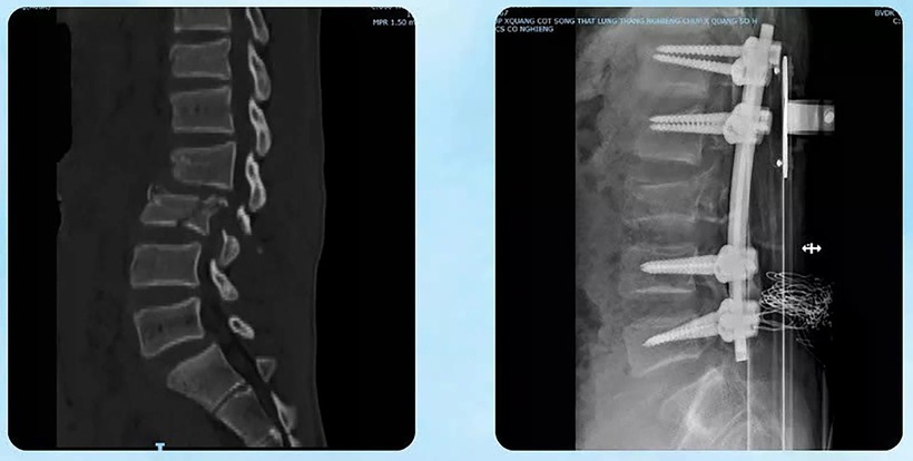 Tình trạng gãy trật cột sống nặng đã được nắn chỉnh thành công. Ảnh: Tri Thức & Cuộc sống.