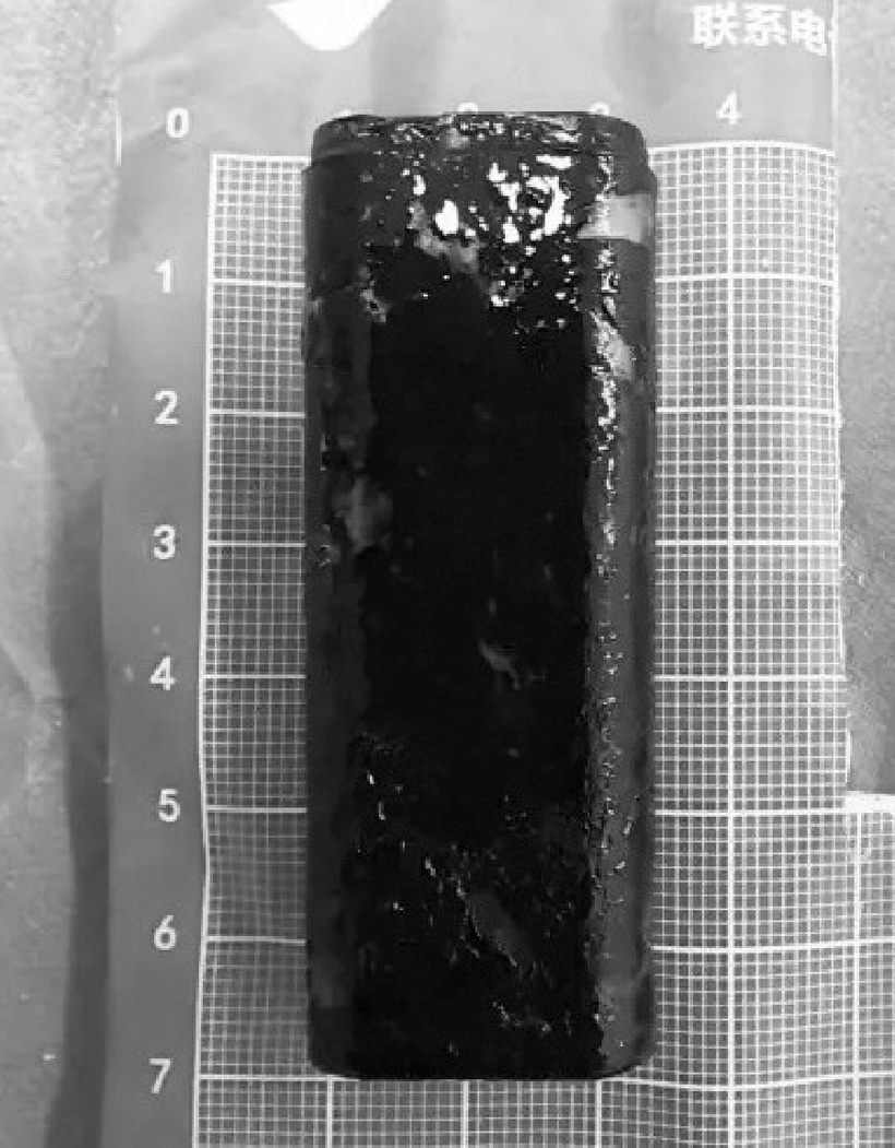 Chiếc bật lửa bị "bỏ quên" 30 năm trong dạ dày người đàn ông 67 tuổi. Ảnh: Red Star News.