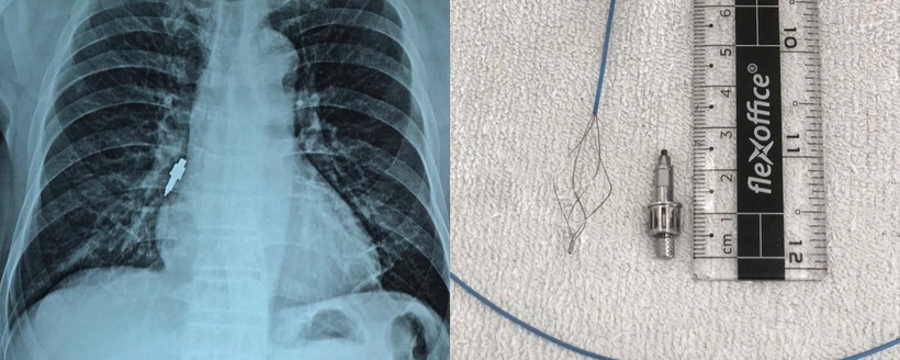 Hình ảnh X quang phát hiện dị vật (trái) trong phế quản bệnh nhân và sau khi đã gắp được dị vật (phải)