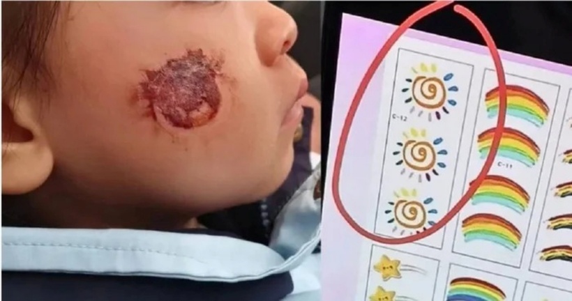Một bé gái 3 tuổi ở tỉnh Hồ Nam, Trung Quốc, đã bị tổn thương da nghiêm trọng sau khi tham gia hoạt động tại trường mẫu giáo.