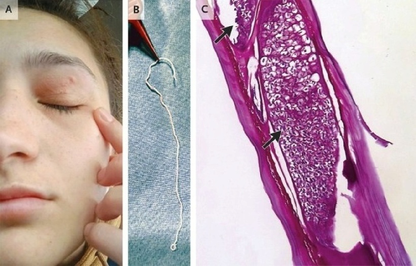 Con giun tròn màu trắng dài tới 11 cm. Ảnh: nejm.org.