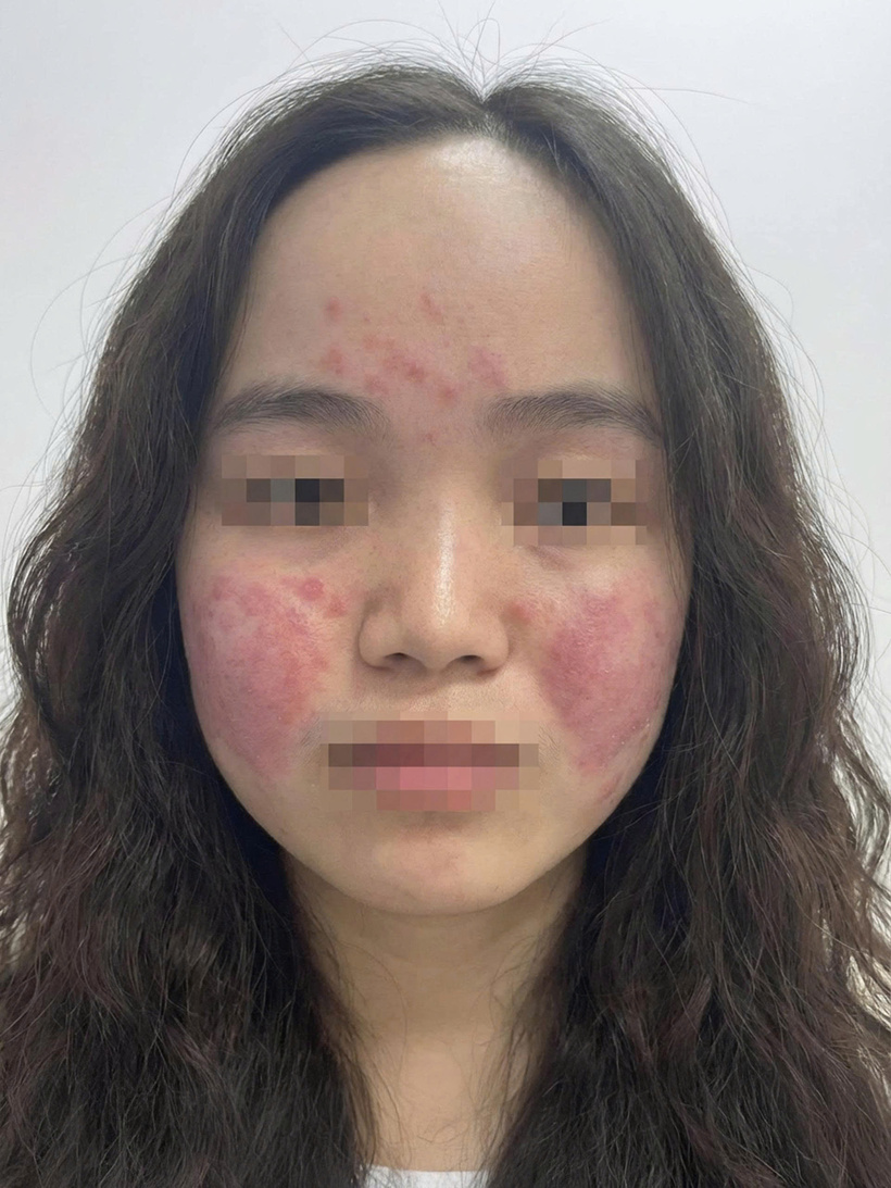 Hà Nội chìm trong sương mù, làn da một số người trẻ “kêu cứu” vì bụi mịn