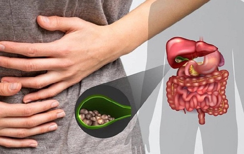 Bệnh nhân bị sỏi mật phần lớn là nữ.