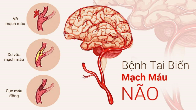 Tai biến mạch máu não xảy ra khi máu không thể lên nuôi não, gây tổn thương các tế bào thần kinh