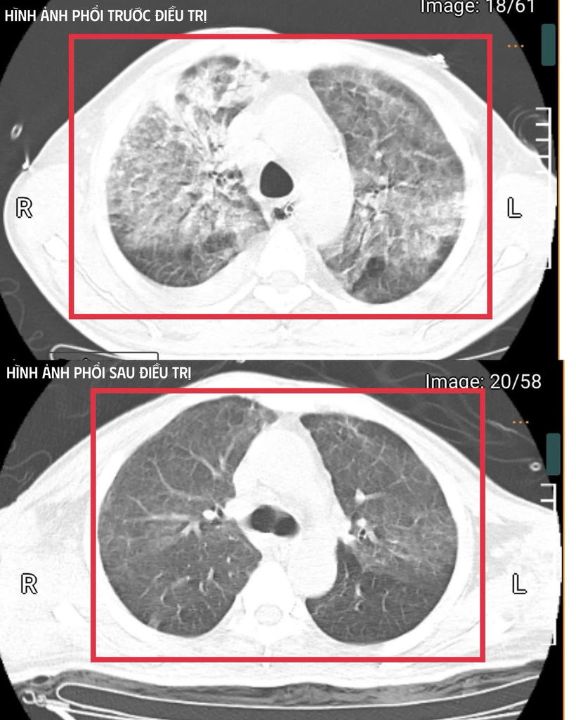 Kết quả cấy máu xác định nhiễm Burkholderia pseudomallei, tác nhân gây bệnh Whitmore