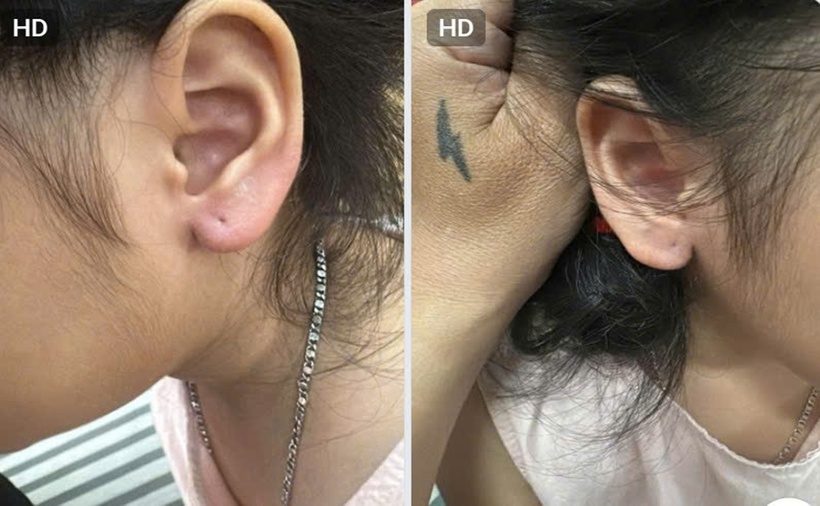 Vùng tai của bé Th bị tổn thương sau khi bị kẻ gian giật mạnh đôi bông tai vàng. (Ảnh: Lao động)