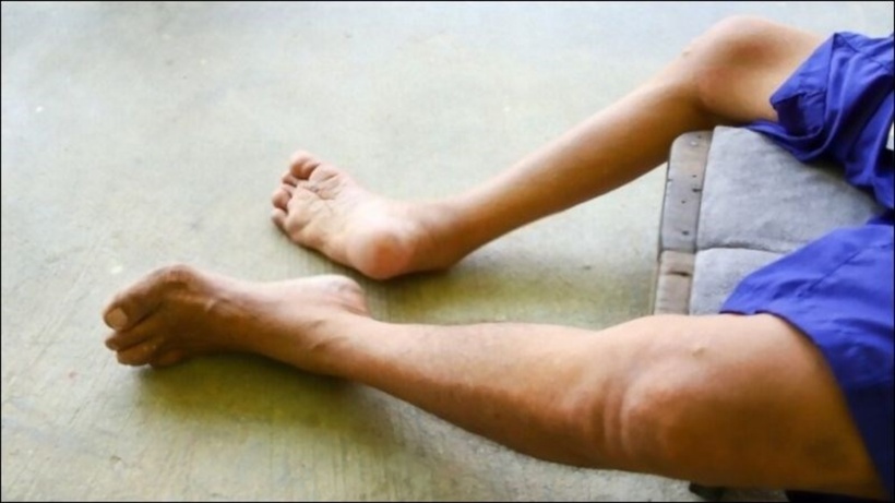 Lào chính thức công bố dịch bại liệt toàn quốc