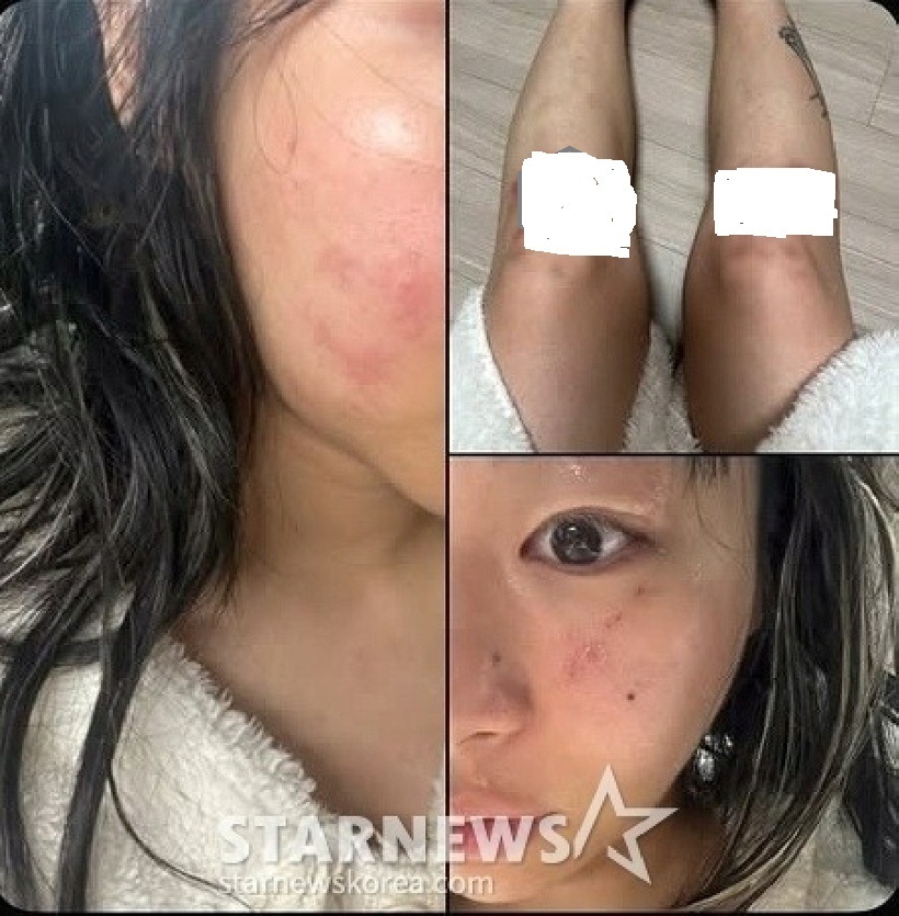 Jvcki Wai chia sẻ trên Instagram loạt ảnh ghi lại vết thương trên mặt và cơ thể cô. Ảnh: Star News Korea.