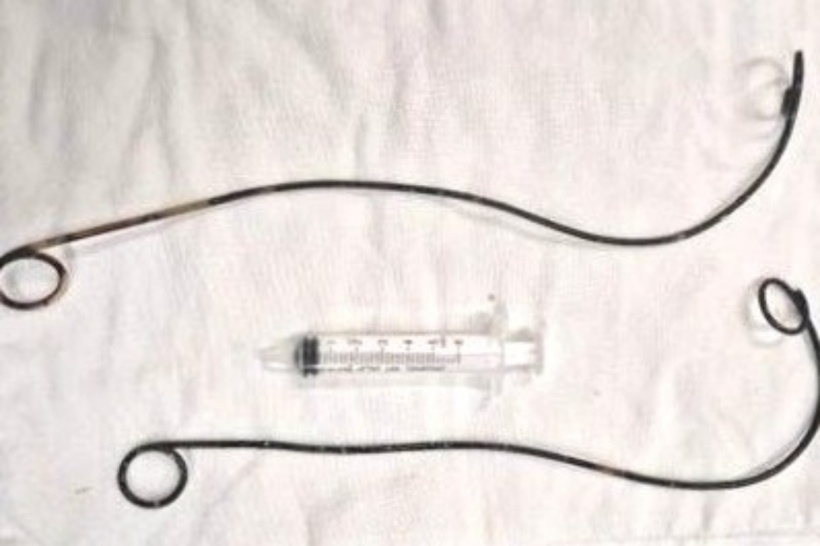 2 ống thông đặt trong người bệnh nhân được lấy ra sau 10 năm. Ảnh: Dân Trí.