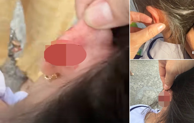 Phụ huynh đăng tải thông tin, hình ảnh con bị giáo viên véo chảy máu tai lên mạng xã hội. Ảnh: VietNamnet