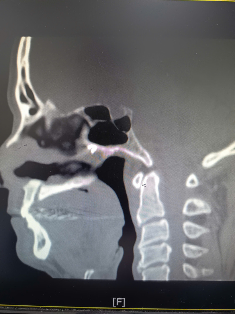 Dị vật nằm sâu, sát vùng trước xoang bướm, vị trí khó tiếp cận. Ảnh: BVCC