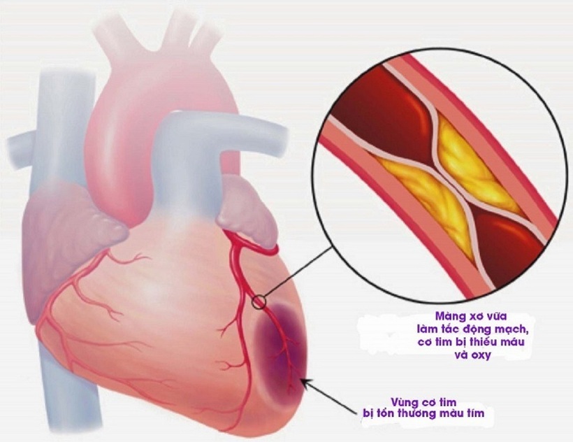 Huyết áp từ 140/90 mmHg trở lên đã được coi là mức làm tăng nguy cơ đột quỵ đáng kể, và mức trên 180/120 mmHg là tình trạng báo động đỏ.