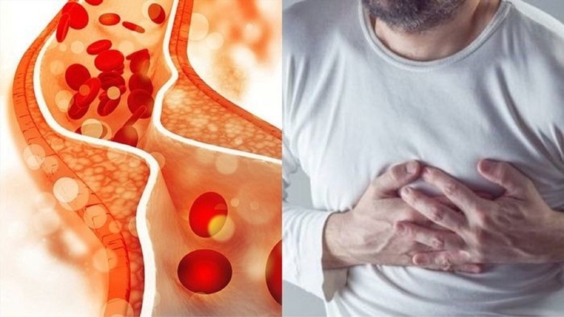 Cholesterol cao là một trong những nguyên nhân hàng đầu dẫn đến các bệnh tim mạch nguy hiểm như xơ vữa động mạch, nhồi máu cơ tim và đột quỵ.