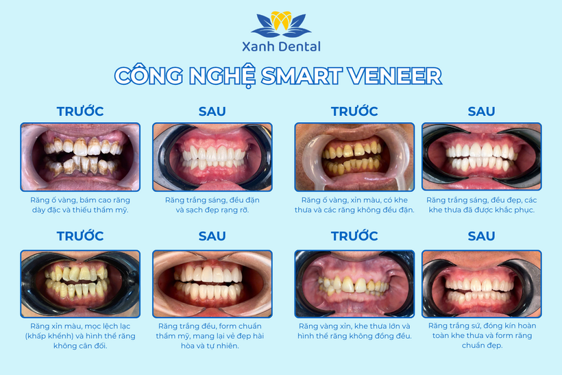 Nha khoa Xanh Dental khai trương cơ sở 2 đột phá với công nghệ Smart Veneer  - 2