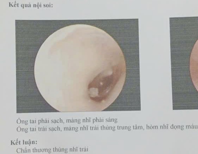 Bác sĩ chẩn đoán H. bị thủng màng nhĩ trái. Ảnh: SK&ĐS.