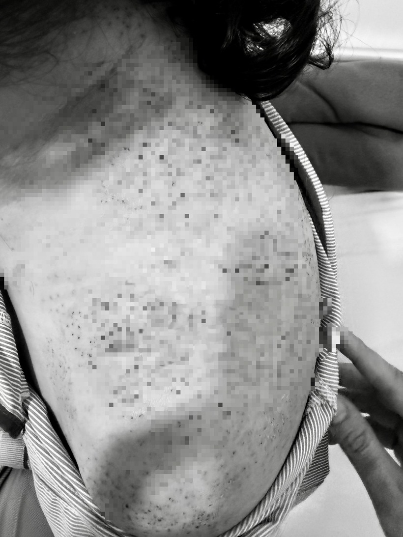 Người phụ nữ bị các triệu chứng bất thường sau khi chích lể, giác hơi. Ảnh: Người Lao Động.