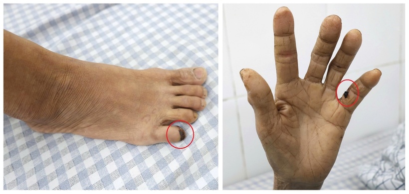 Chủ quan với vết xước do gà đạp, người bệnh nhập viện trong tình trạng uốn ván toàn thể