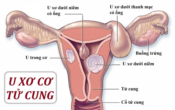 U xơ trong cơ tử cung khá phổ biến ở phụ nữ độ tuổi sinh sản
