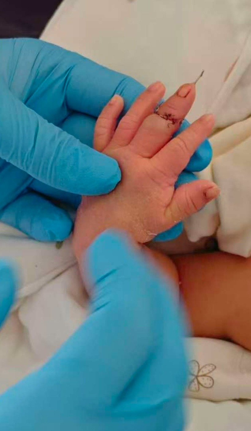 Một bé trai sơ sinh tại Giang Tô vừa được phẫu thuật nối lại ngón tay sau sự cố bị y tá cắt nhầm trong lúc cắt dây rốn. Ảnh: Red Star News