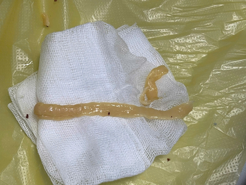 Hình ảnh đoạn sán màu trắng ngà, dài hơn 80cm được gắp từ trong lòng đại tràng của bệnh nhân