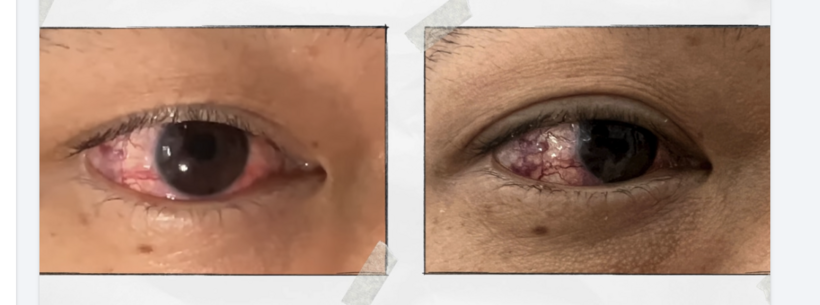 Đỏ mắt kéo dài không khỏi, bác sĩ phát hiện thông động mạch cảnh xoang hang