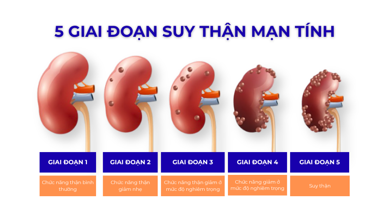 Suy thận độ 3 là khi mức độ lọc cầu thận giảm rõ rệt