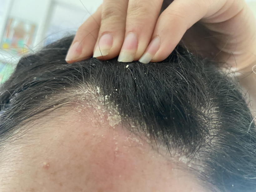 Gàu là nỗi ám ảnh của nhiều người trưởng thành.