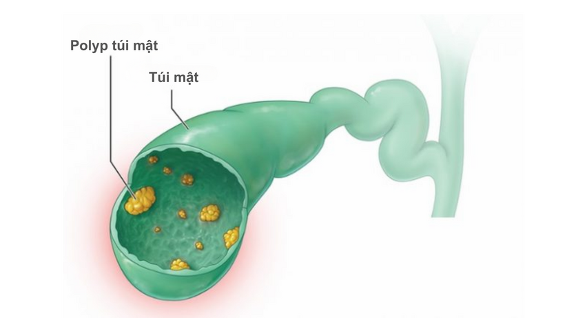 Mổ polyp túi mật liệu có nguy hiểm cho người bệnh